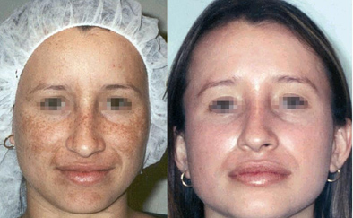quick and easy melasma removal, affordable pregnancy mark pigmentation removal